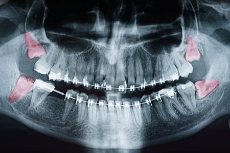 wisdom teeth in need of extraction