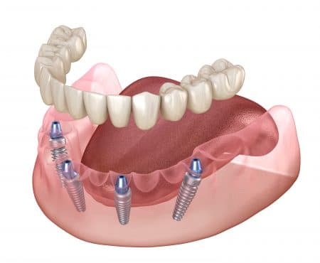 all-on-4 implant dentures