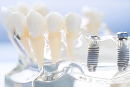 dental implant 