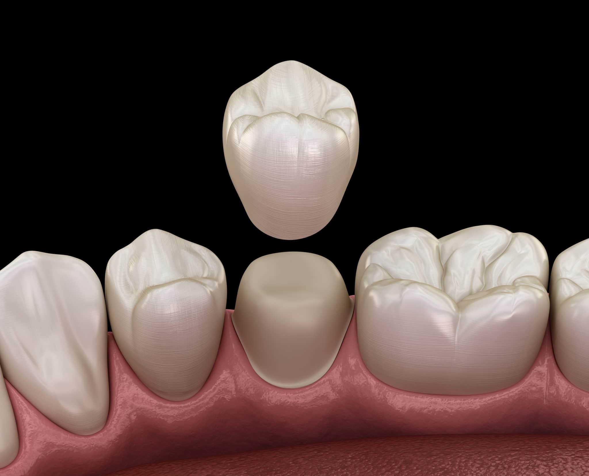 Overland Park Dentist Explains How A Crown Fixes Broken Teeth