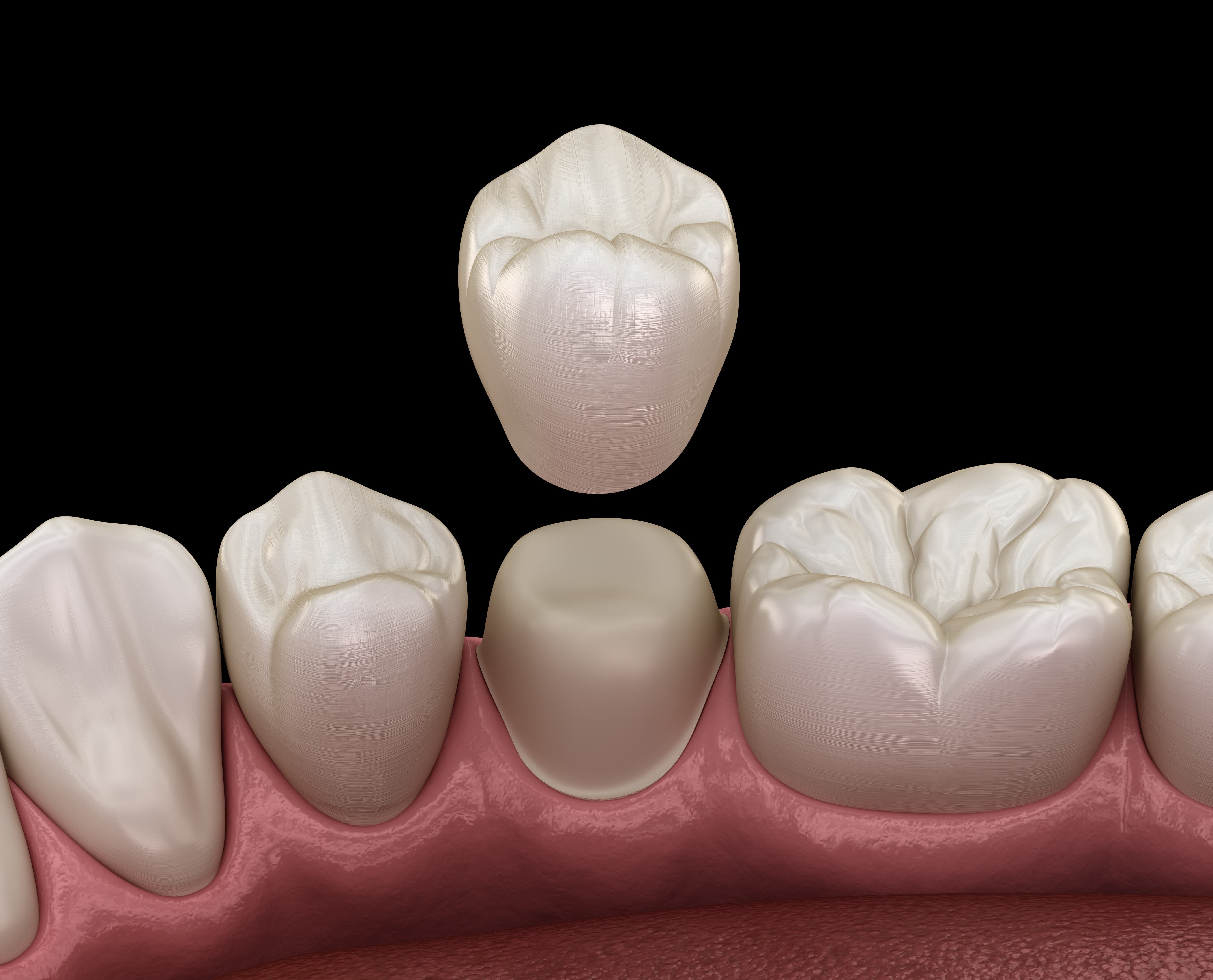 Damaged Tooth Repair With a Dental Crown - Frankford Dental Care  Philadelphia Pennsylvania