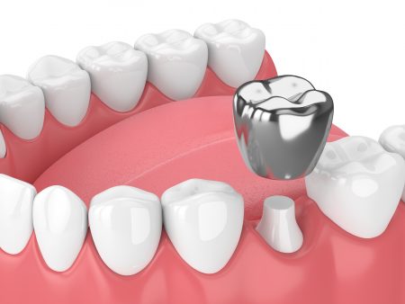 3d render of teeth with dental crown amalgam fillingover white background