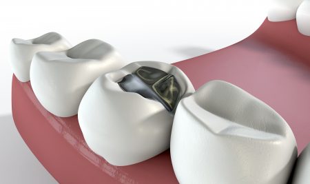 A lead cavity filling on one molar in a set of false human teeth set in gums with on an isolated background