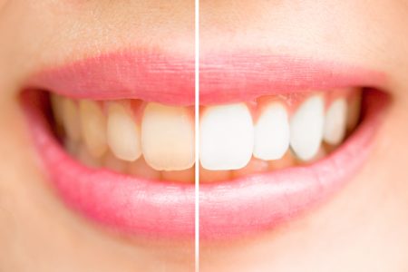 Close-up teeth female between before and after brush the teeth.