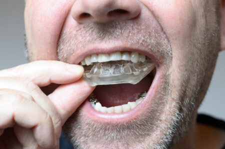 Man placing a bite plate in his mouth to protect his teeth at night from grinding caused by bruxism, close up view of his hand and the appliance