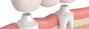 3d render of dental bridge with dental crowns in gums