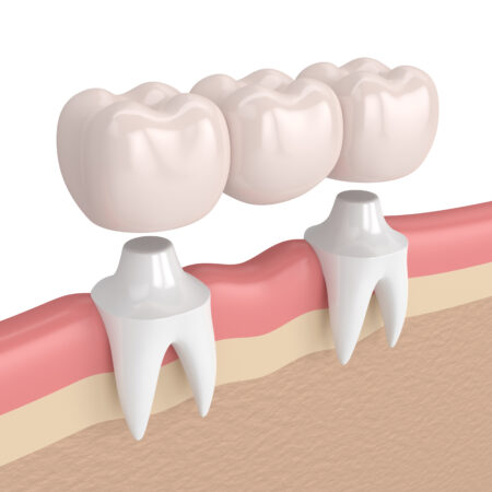 3d render of dental bridge with dental crowns in gums