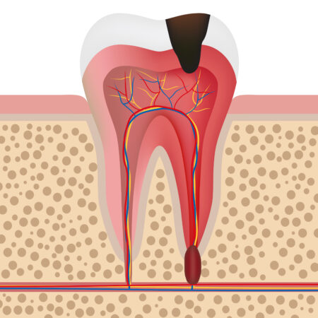Vector illustration showing infected tooth with pulpitis.
