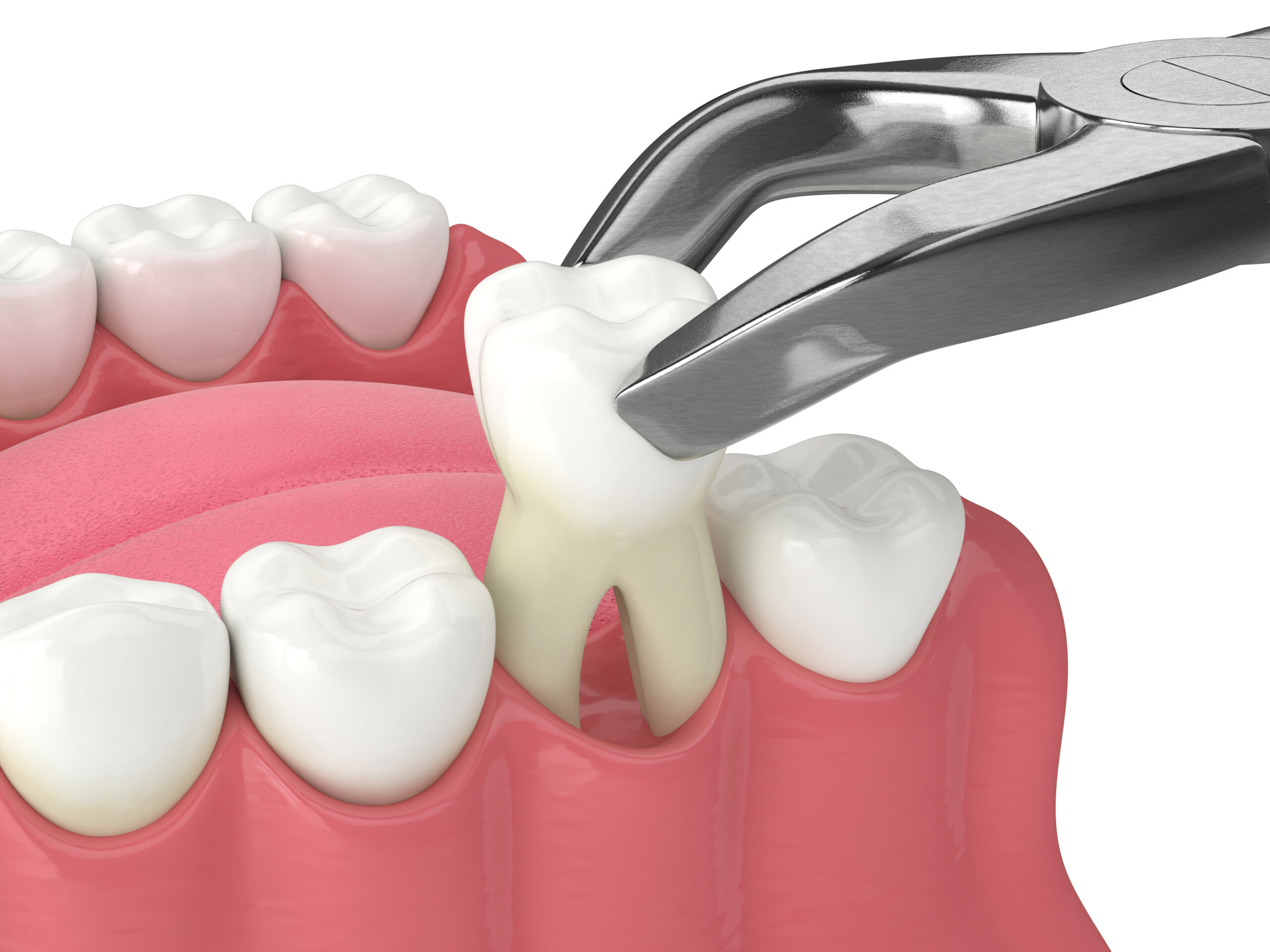 Overland Park, KS dentist offers tooth extractions when necessary 