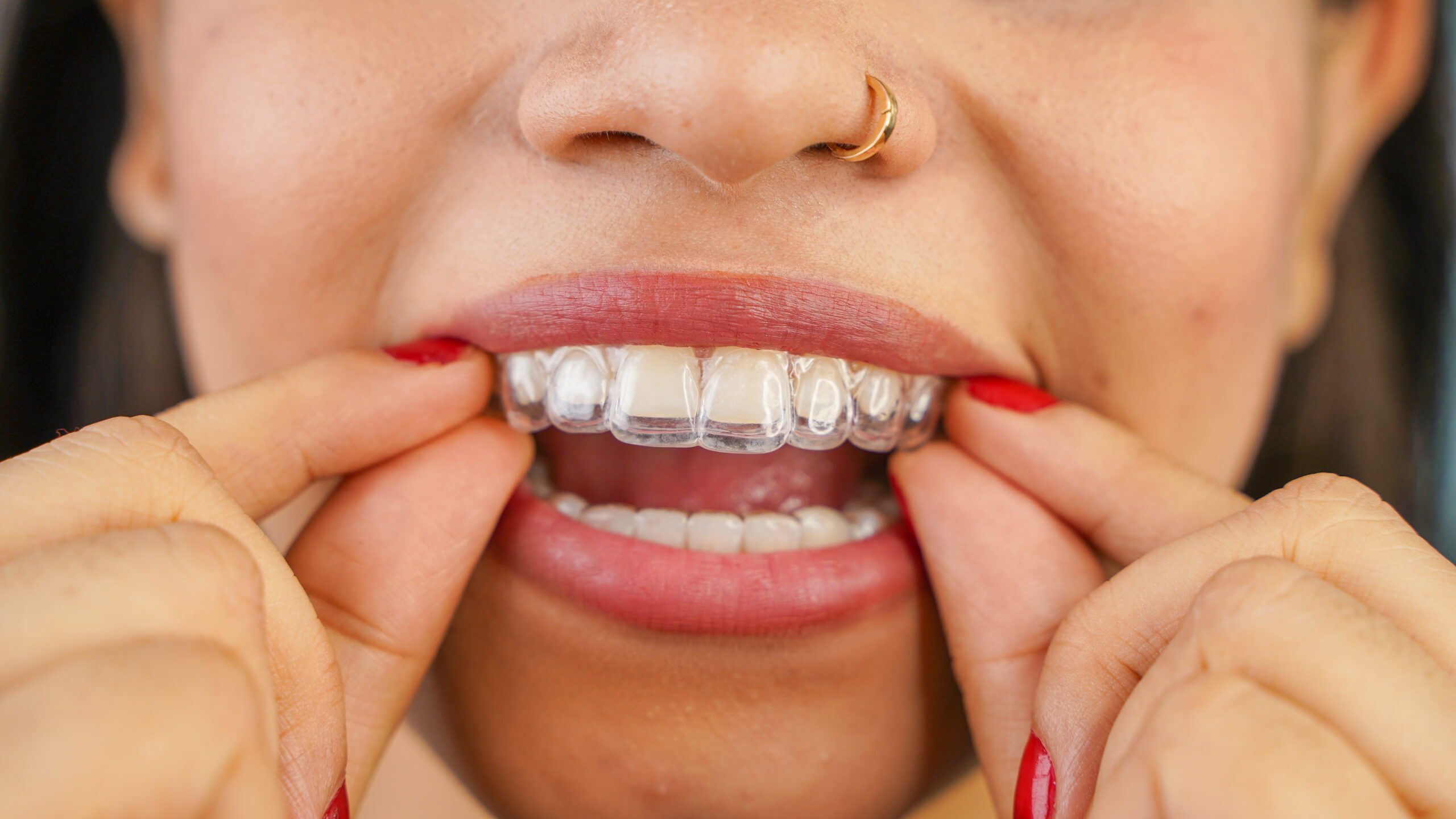 Overland Park, KS, dentist offers Invisalign