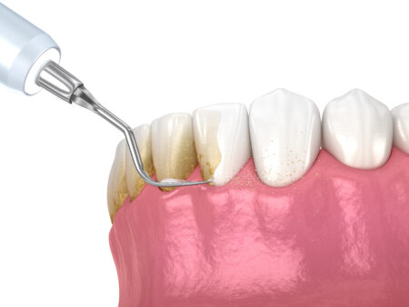 overland park periodontal treatment